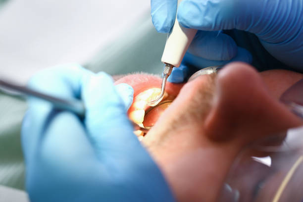 Best Emergency Dental Care for Broken or Chipped Teeth in Marceline, MO